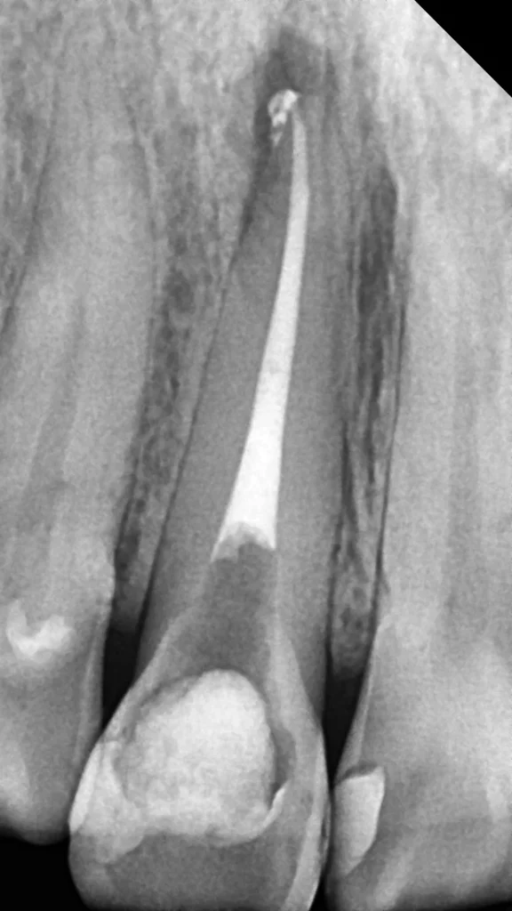 앞니 재신경치료 완료 후 X-ray 사진