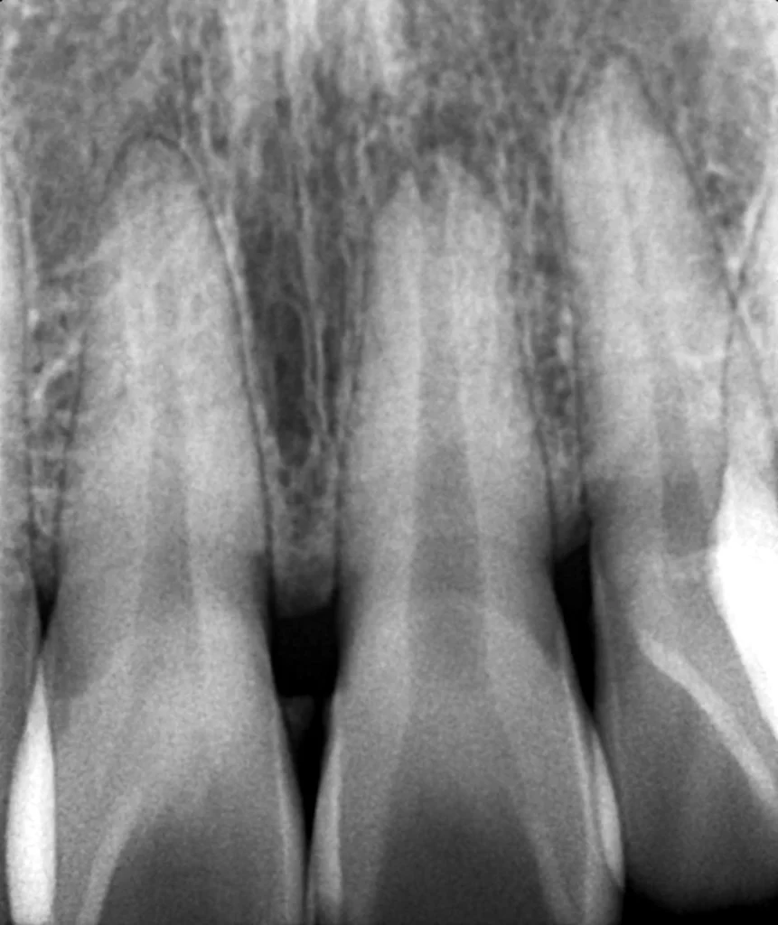 변색 앞니 신경 괴사 확인용 X-ray