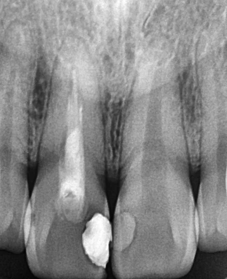 변색 앞니 기존 신경치료 상태 X-ray