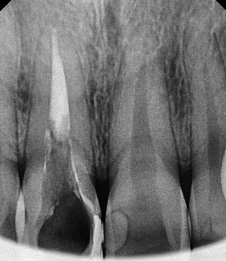 앞니 재신경치료 진행 중 X-ray