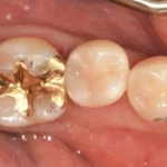 소구치 사이 충치, 인레이 대신 Palodent 시스템을 이용한 당일 레진 빌드업