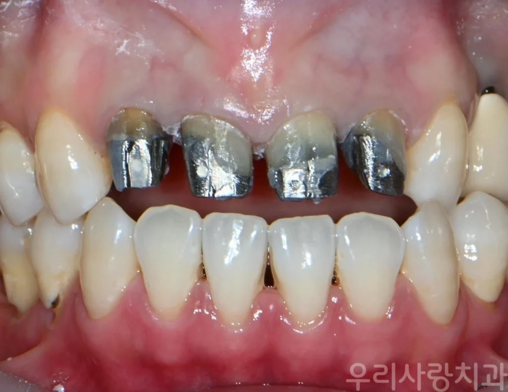 기존 보철물 제거 후 정면에서 본 앞니 주조 금속 기둥