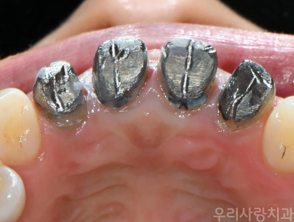 씹는 면에서 바라본 앞니 주조 금속 기둥 모습
