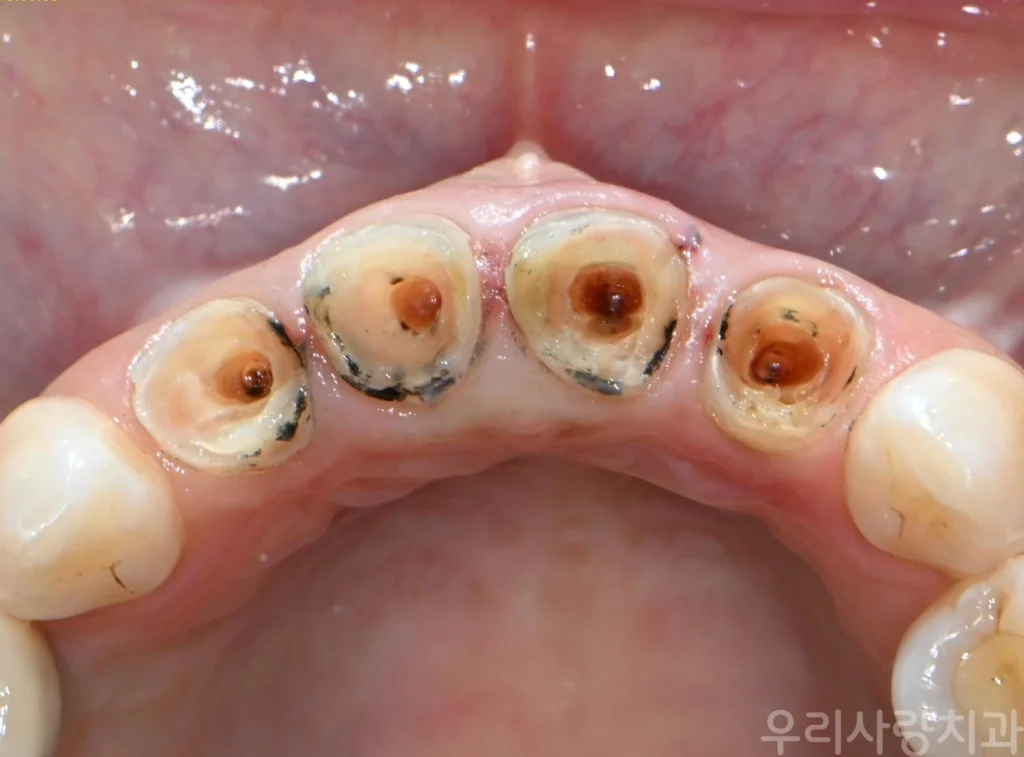 금속 기둥 제거 후 치아 내부가 드러난 앞니 상태