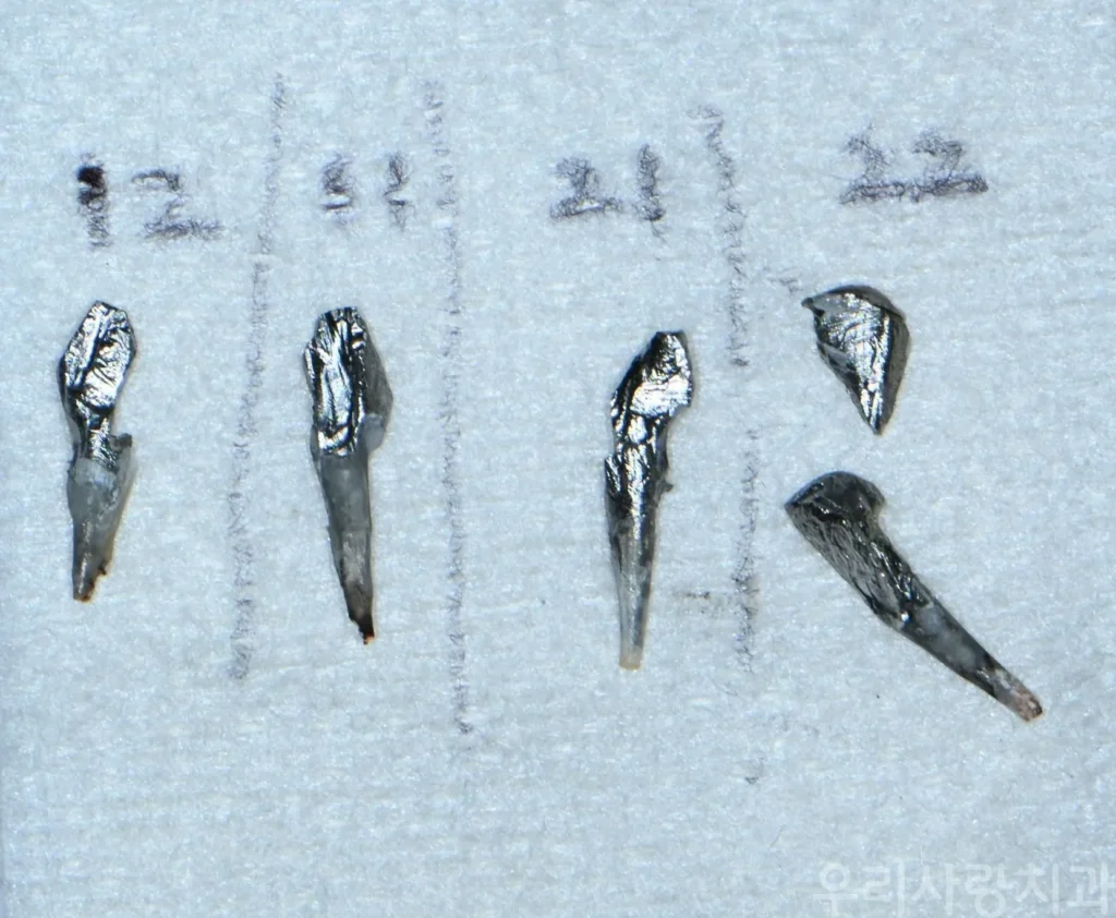 치아 파절 없이 안전하게 제거된 4개의 주조 금속 기둥