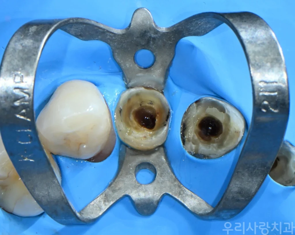 러버댐 방습 하에 진행하는 앞니 신경관 정리 및 치료 과정