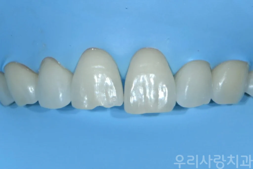 앞니 레진 치료를 위한 러버댐 방습 장착 모습