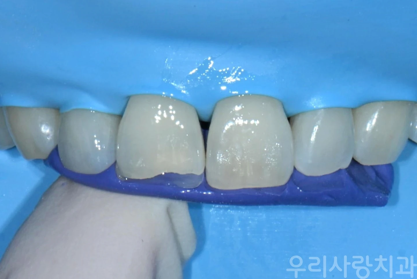 실리콘 인덱스를 활용한 앞니 레진 형태 가이드 적용
