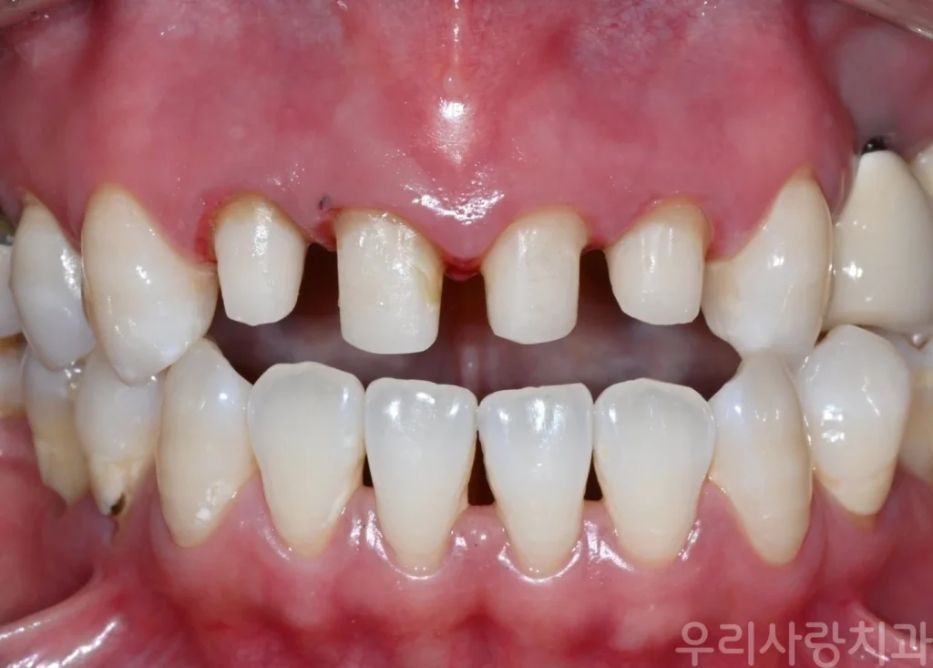 실활치 미백과 레진 코어로 깨끗하게 정리된 앞니 지대치