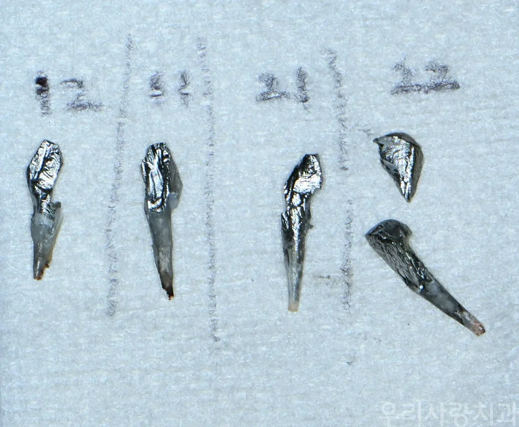 거즈 위에 치아 번호별로 정리된 미세 분리 제거된 4개의 주조 금속 기둥 파편 실물 사진