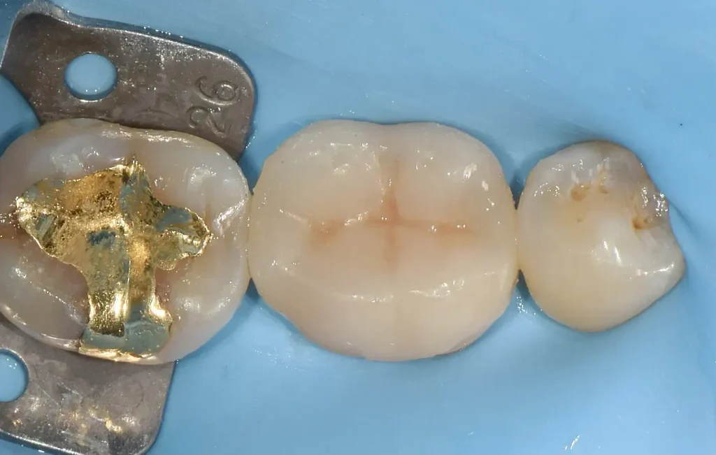 세라믹 오버레이를 접착한 직후 자연스러운 치아 외형과 건강한 잇몸 조화를 보여주는 구강 내 정면 사진