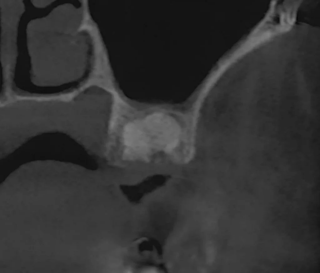 치조제 보존술 3개월 후 3차원 CT 단면을 통해 충분한 골량과 식립 위치를 정밀 계측하는 단계