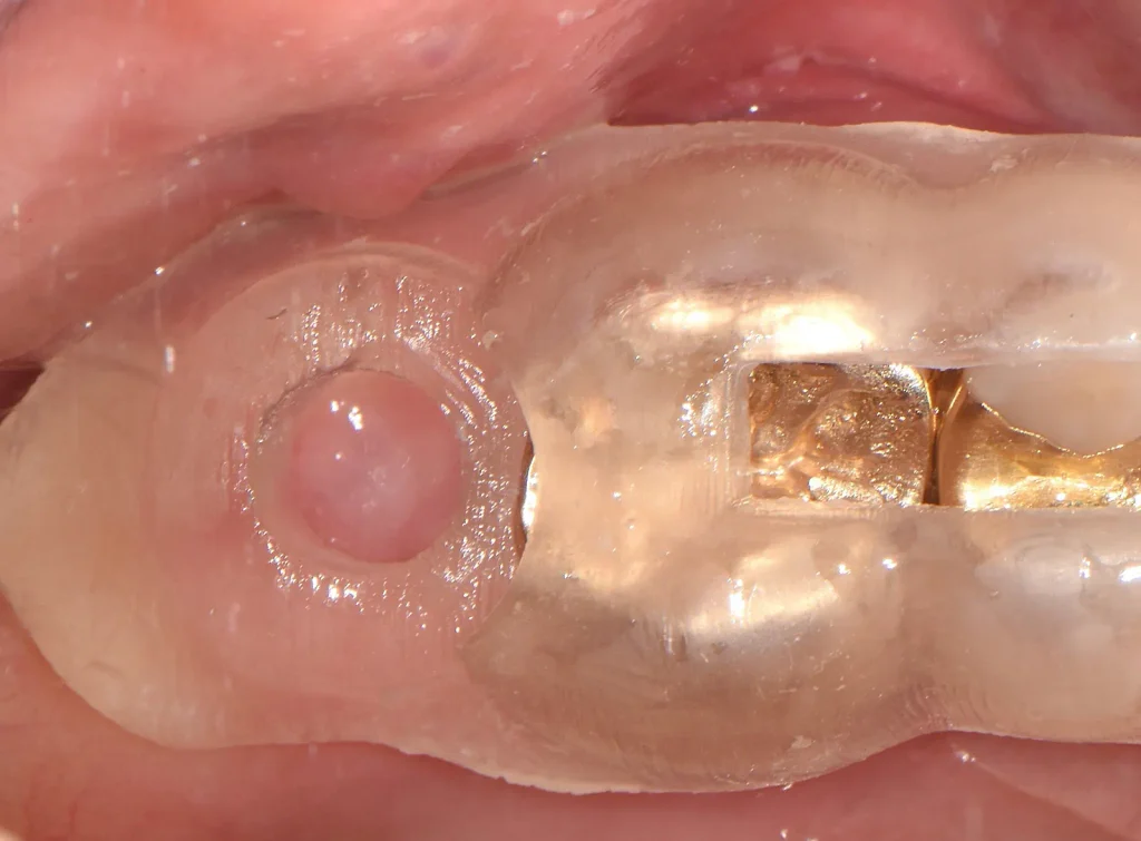 환자의 치열에 정확히 장착된 3D 디지털 수술 가이드를 통해 무절개 임플란트 식립을 진행하는 과정