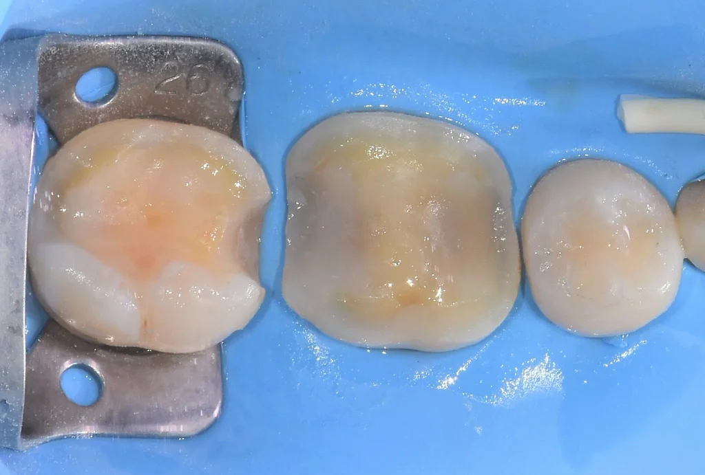 파란색 러버댐 시트로 어금니를 완벽히 격리한 후 충치를 제거하고 교합면을 2~3mm 삭제한 모습