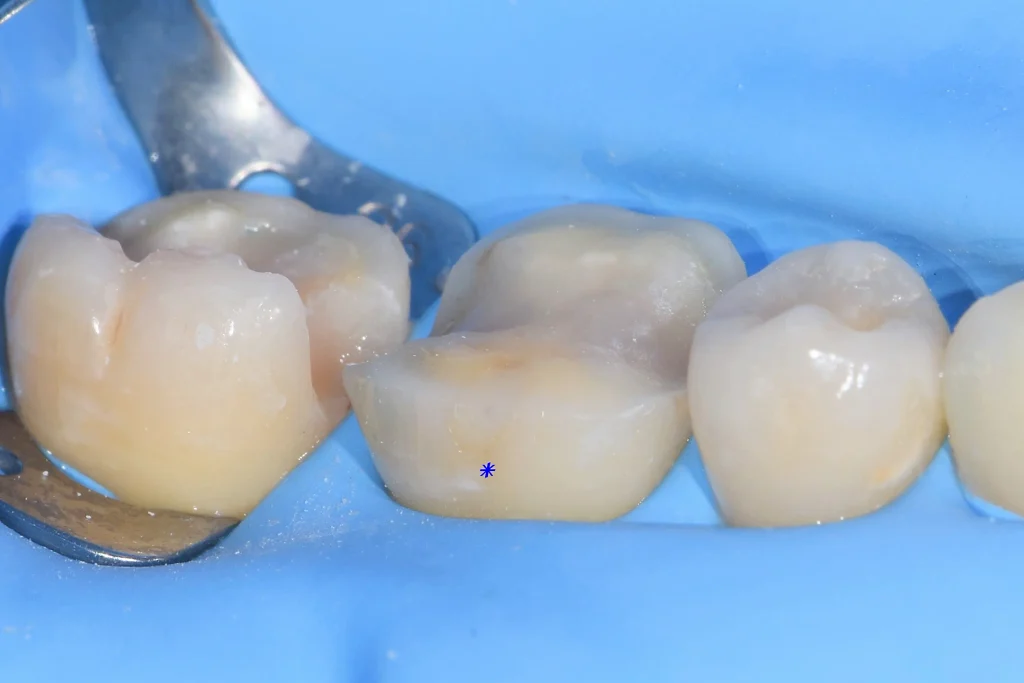 러버댐 하에서 세팅 직전 치아 측면을 관찰하여 치경부 외벽이 보존되어 있음을 표시한 사진