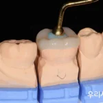 어금니 인레이 아래 2차 충치와 크랙, 크라운 대신 오버레이를 고려하는 기준